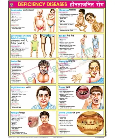 Deficiency Diseases Chart, English-Hindi