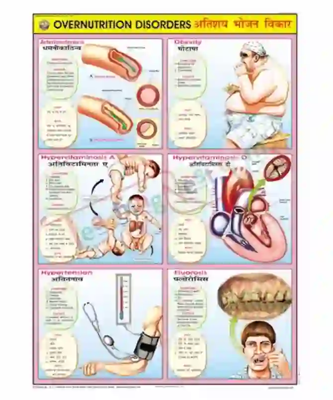 Overnutrition Disorders Chart, English-Hindi