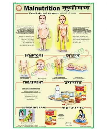 Malnutrition Chart, English-Hindi