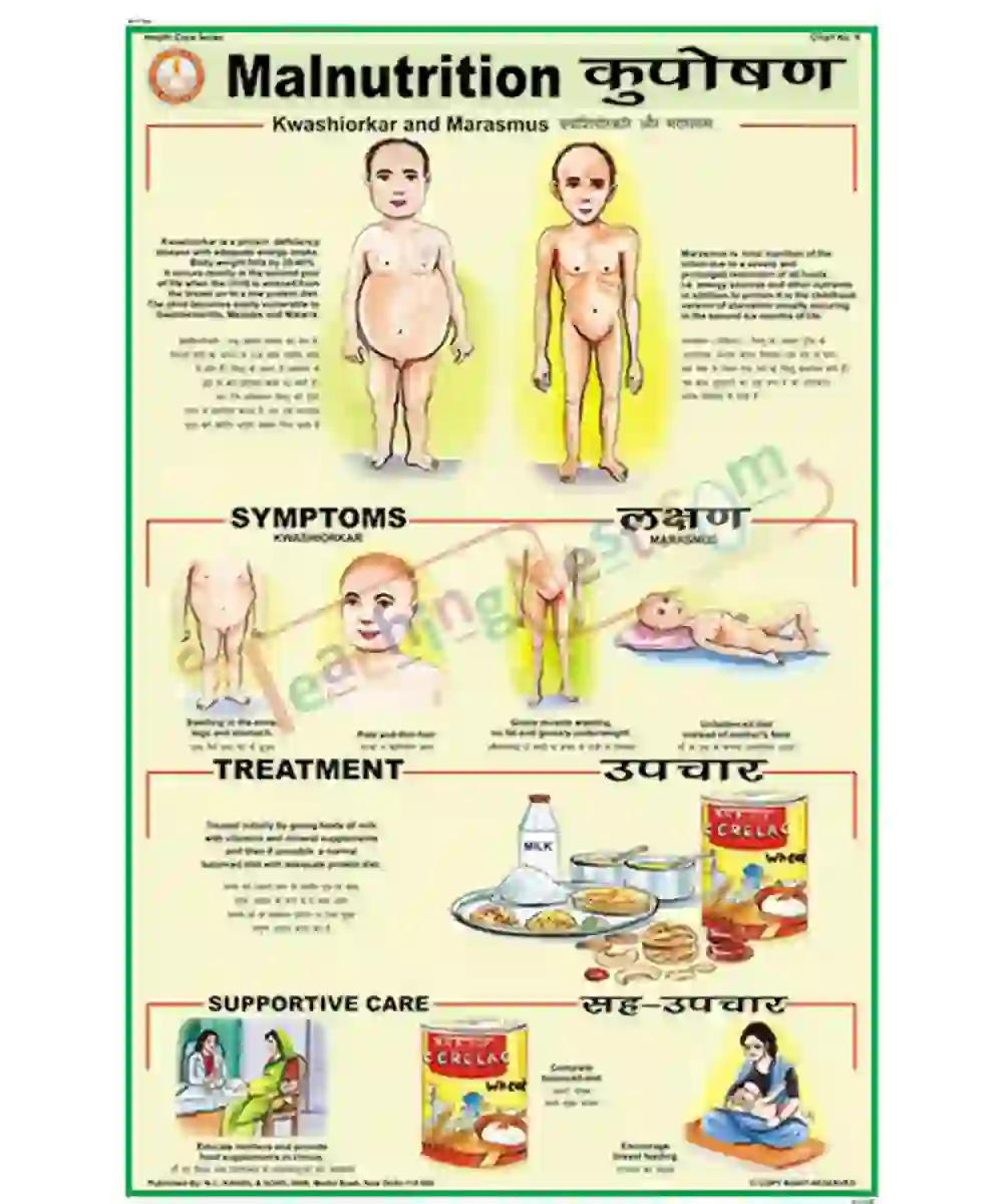 Malnutrition Chart, English-Hindi