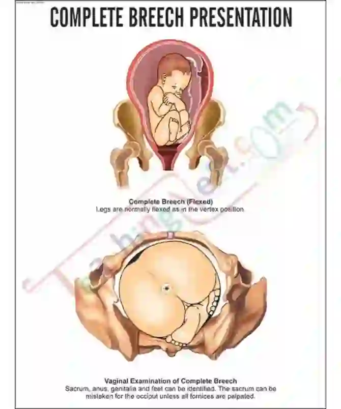 Complete Breech Presentation Chart, 51x66 cm