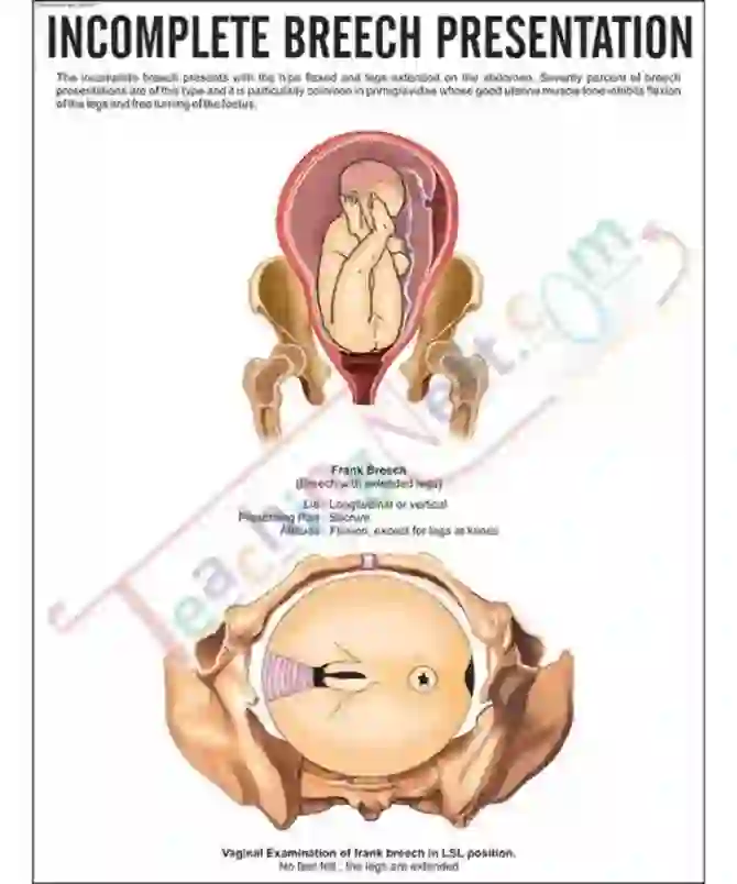 Incomplete Breech Presentation Chart, 51x66 cm