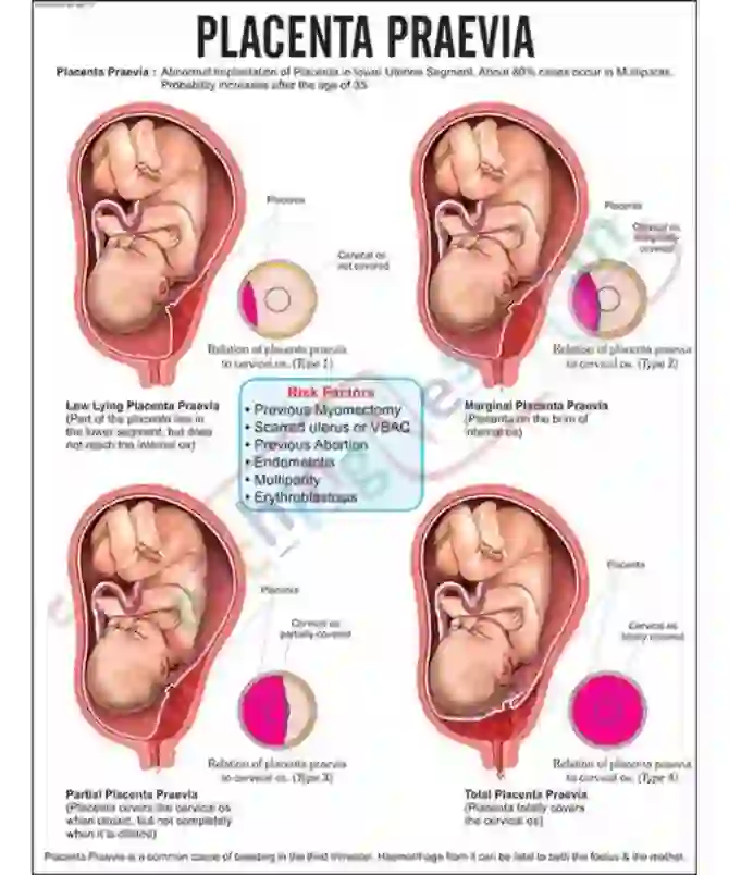 Placenta Praevia Chart, 51 x 66 cm