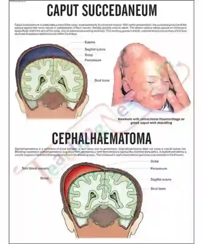 Caput Succedaneum, Cephalhaemat. Chart, 51x66cm