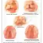 Cleft lip-Palate Chart, 51 x 66 cm