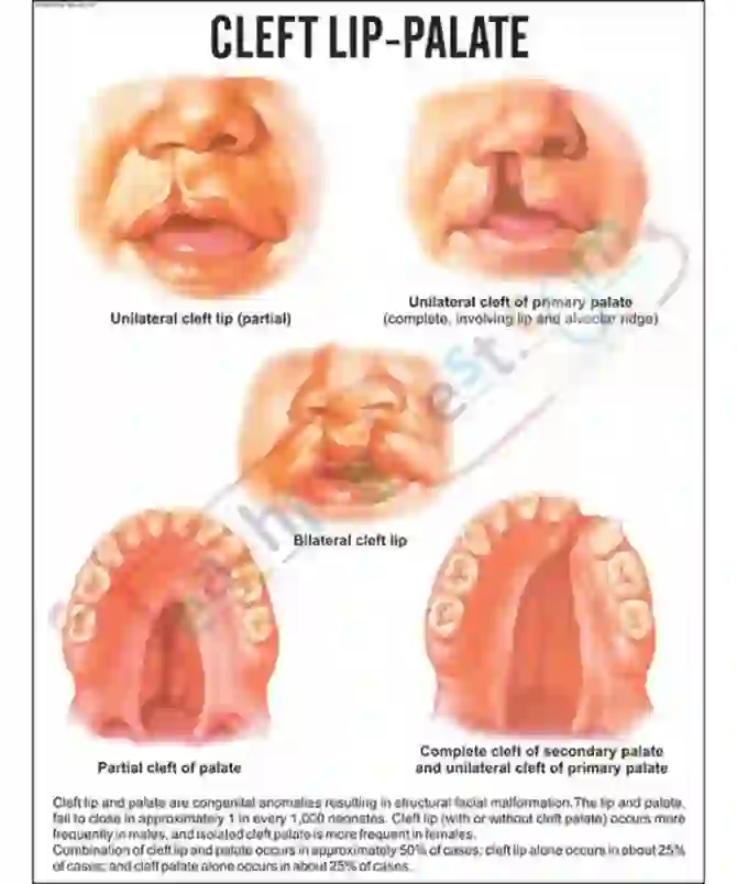 Cleft lip-Palate Chart, 51 x 66 cm