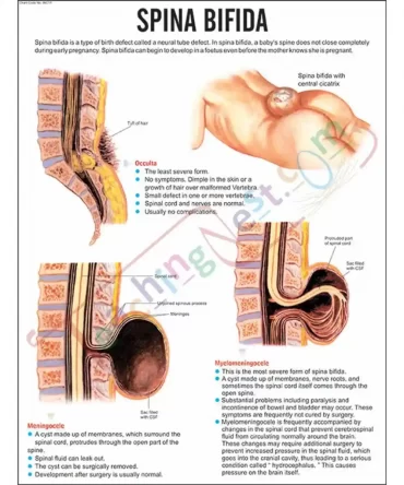 Spina Bifida Chart, 51 x 66 cm