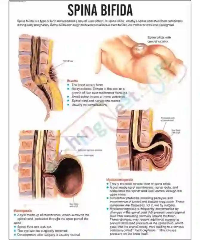 Spina Bifida Chart, 51 x 66 cm