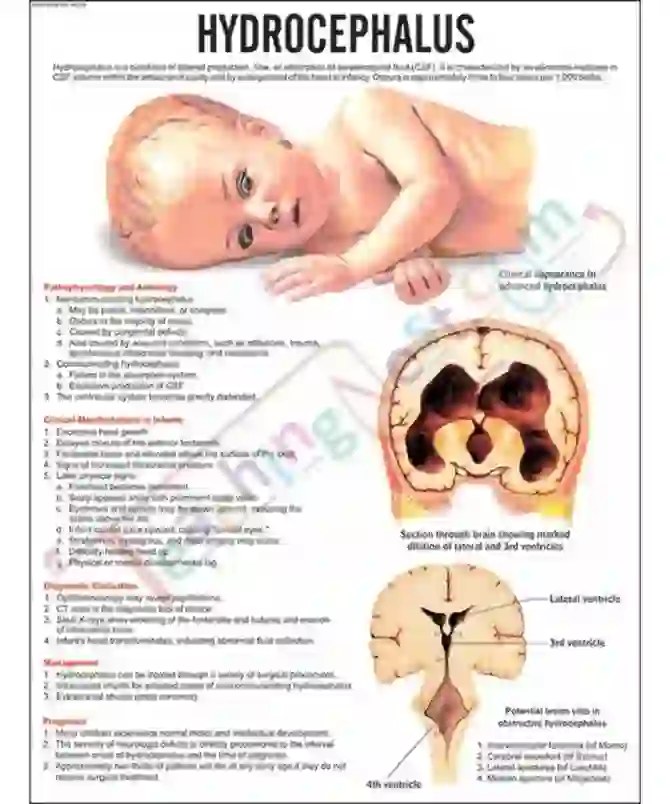 Hydrocephalus Chart, 51 x 66 cm