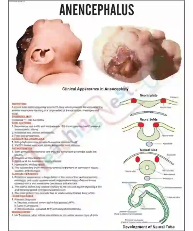 Anencephalus Chart, 51 x 66 cm